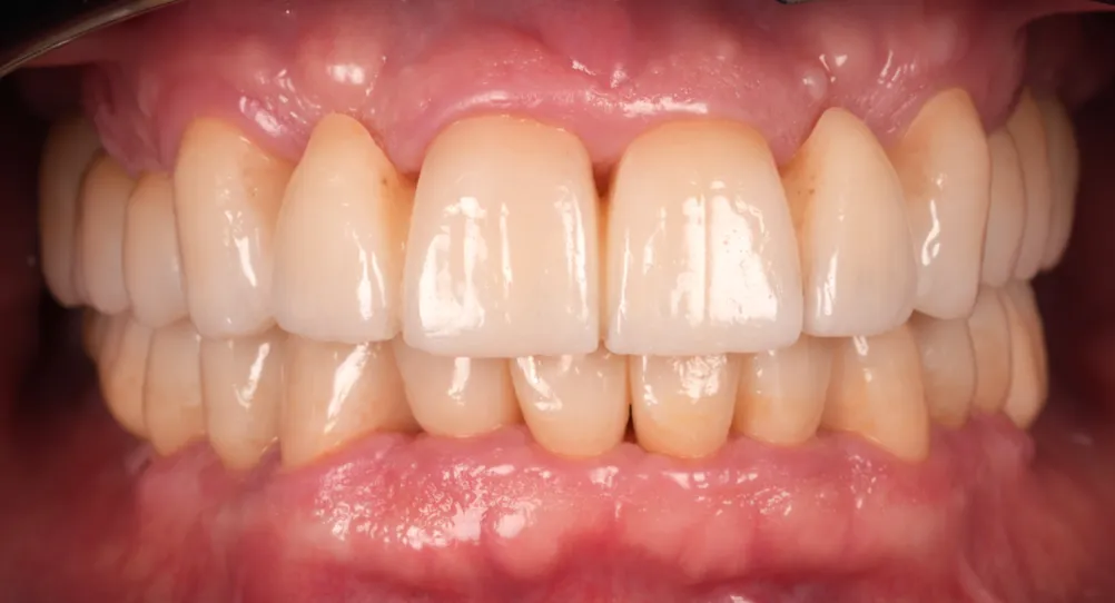 After prosthetic rehabilitation