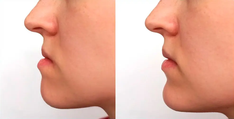 Orthognathic Surgery: before and after