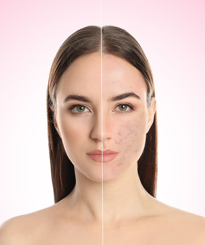 Before and after acne scar treatment on woman’s face