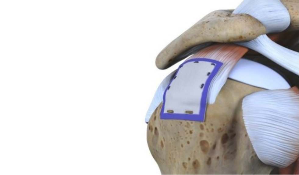 REGENETEN Bio inductive Implant
