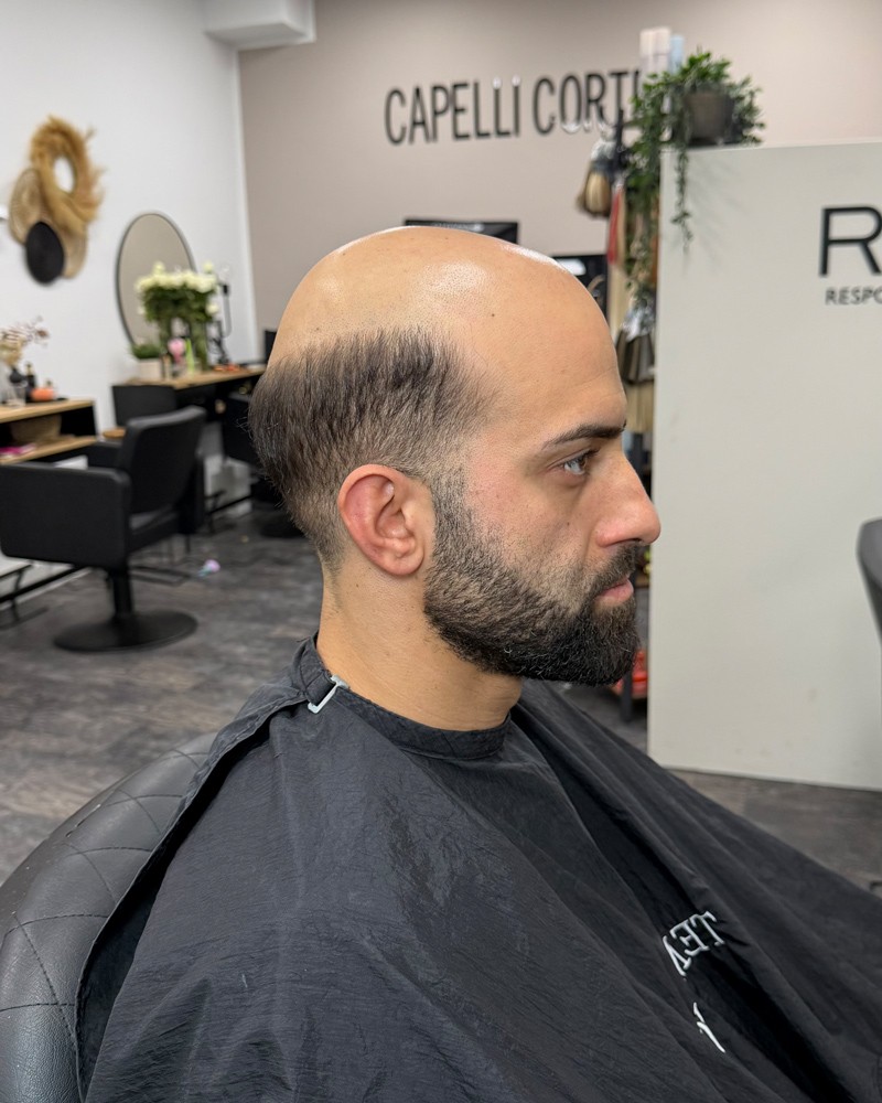 Cortese Haarsysteme - Vorher-Ansicht 1