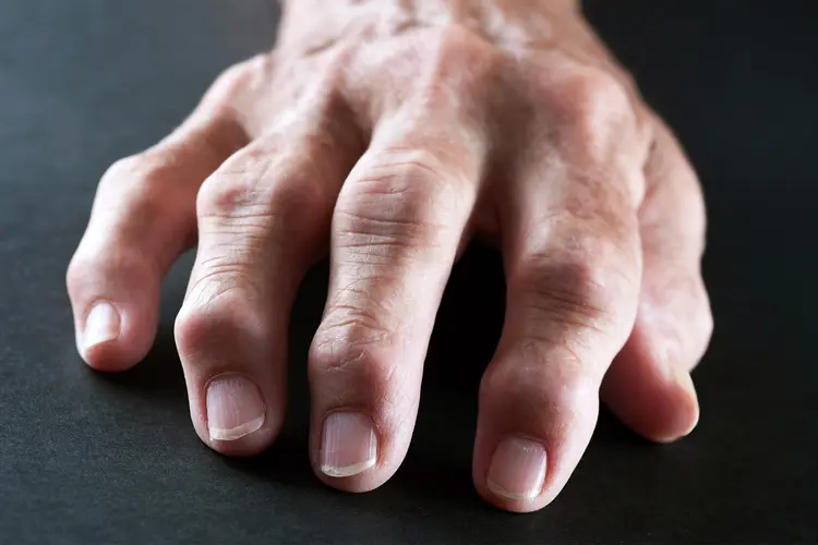 hand with arthritis