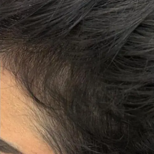 After growth factors hair treatment at The Vancouver Aesthetician — dormant follicles reactivated, hairline visibly restored and hair noticeably thicker and fuller