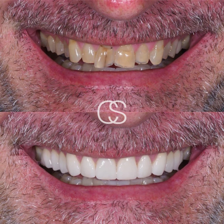 Before & After Crowns at Colac Smiles, Colac