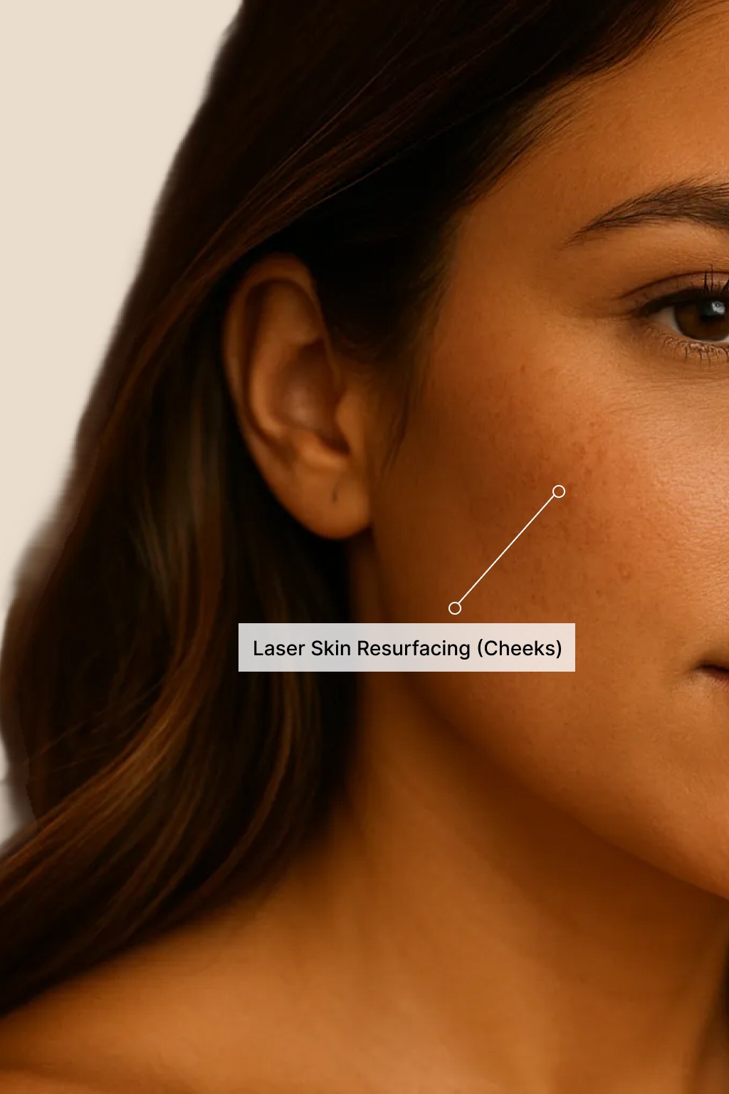 Close-up of a woman’s cheek with a label indicating the treatment area for Laser Skin Resurfacing