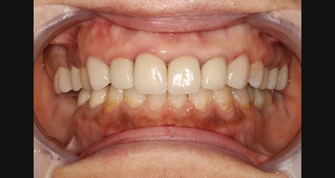 13,23 라미네이트 셋팅 e.max