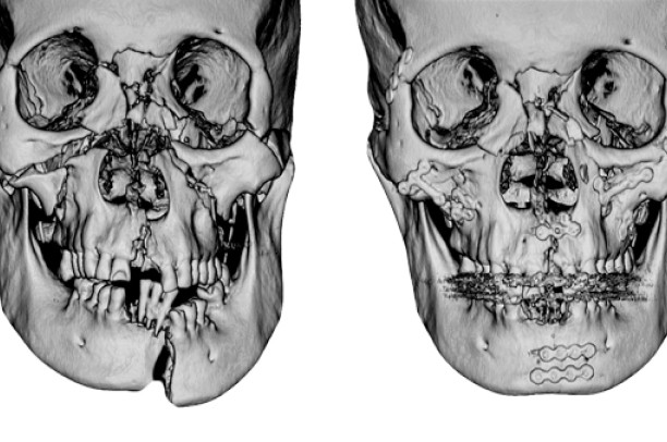 Tratamento de fraturas faciais - Dr Bruno Gomes Bucomaxilo