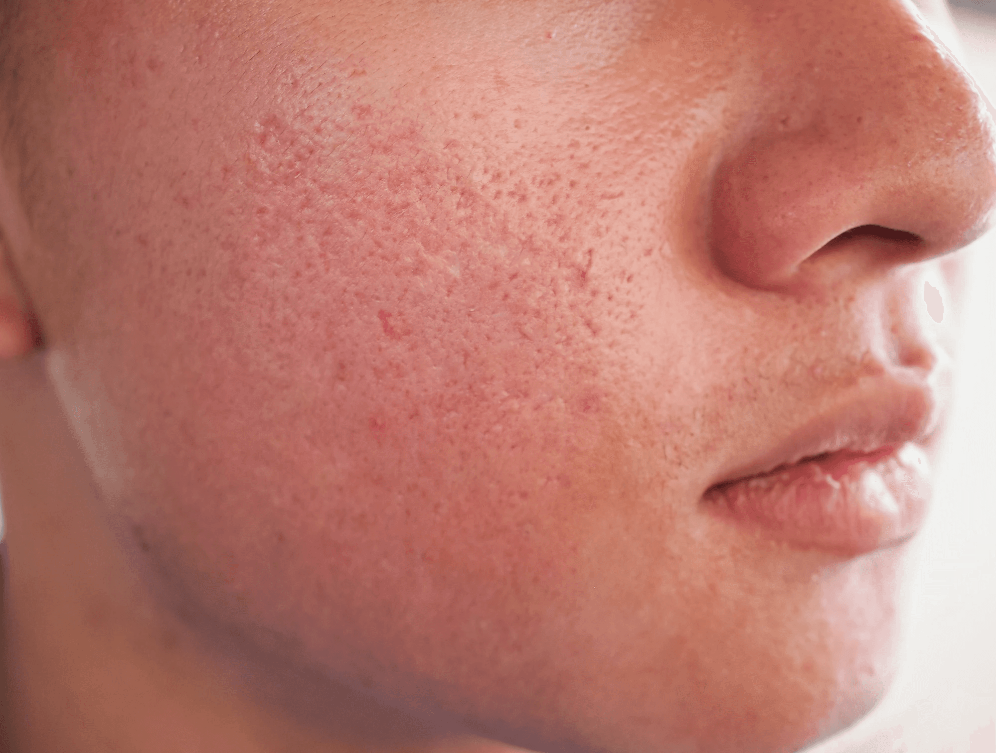 acne scars and enlarged pores on the cheek skin 