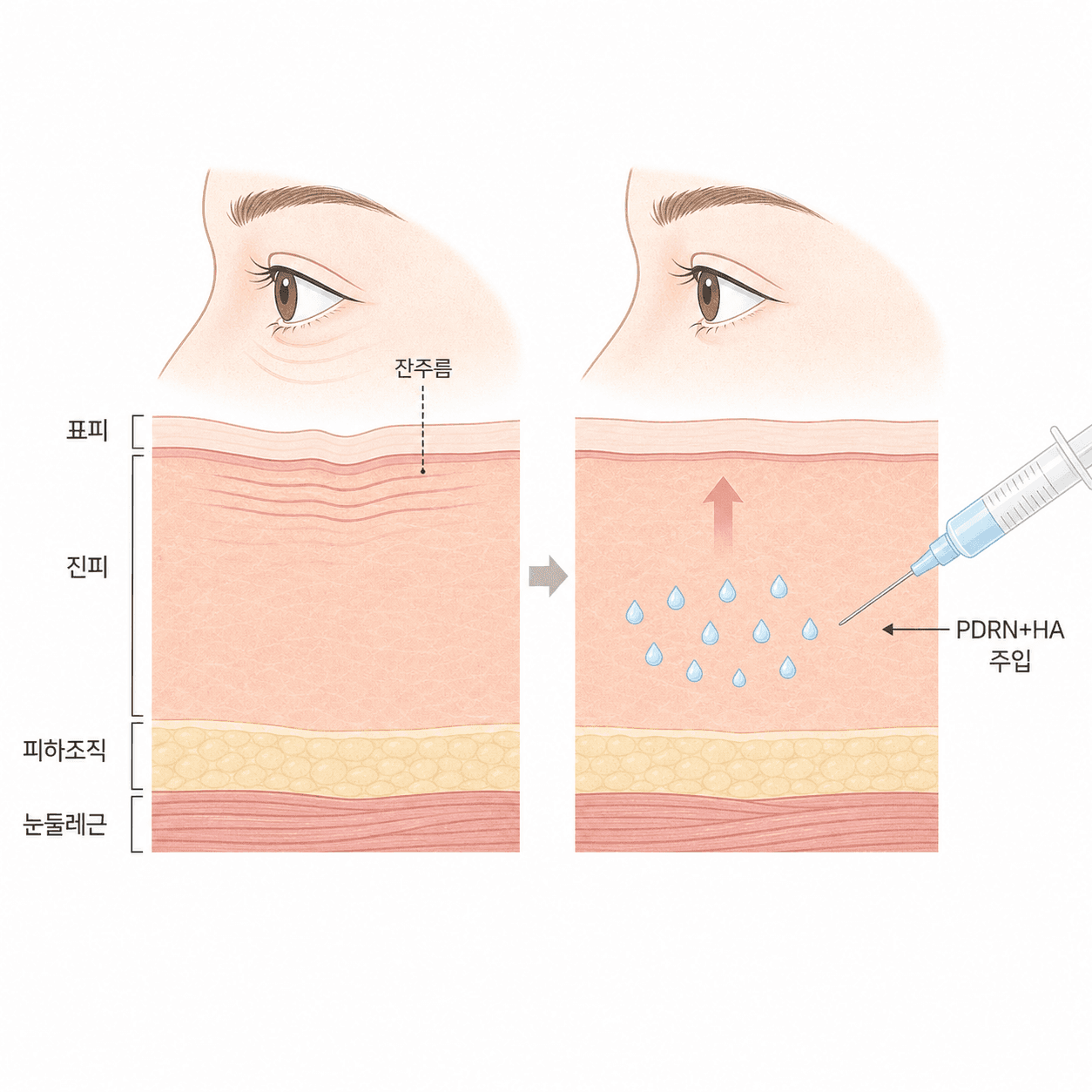 눈가 얇은 피부층과 PDRN·HA 스킨부스터가 진피에 작용하는 구조