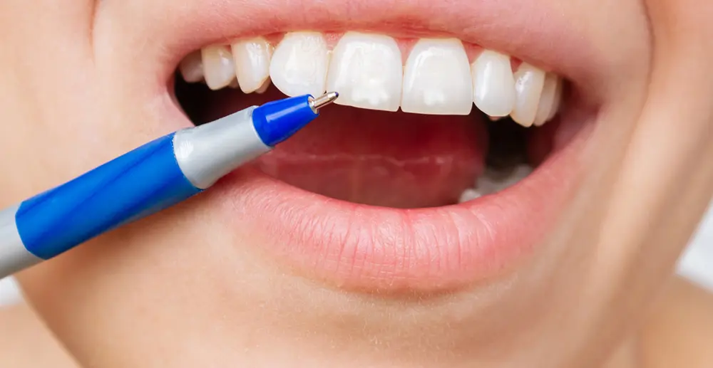 Fluorose dentária: Sintomas e tratamento