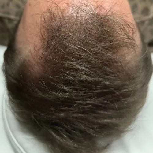 After exosome PDRN therapy hair treatment at The Vancouver Aesthetician — male pattern balding visibly restored with noticeably thicker and fuller hair growth
