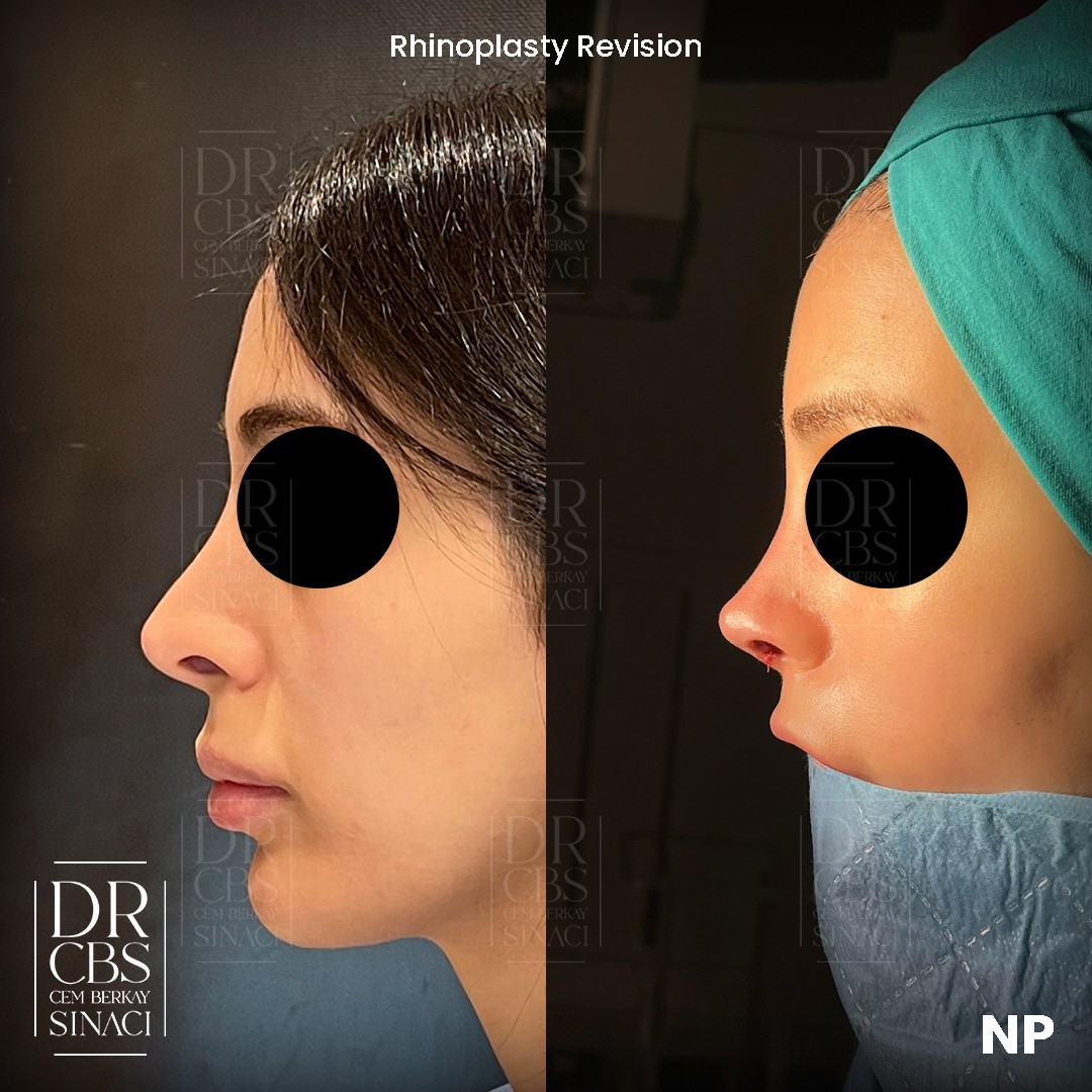 immediate before after of revision rhinoplasty side view