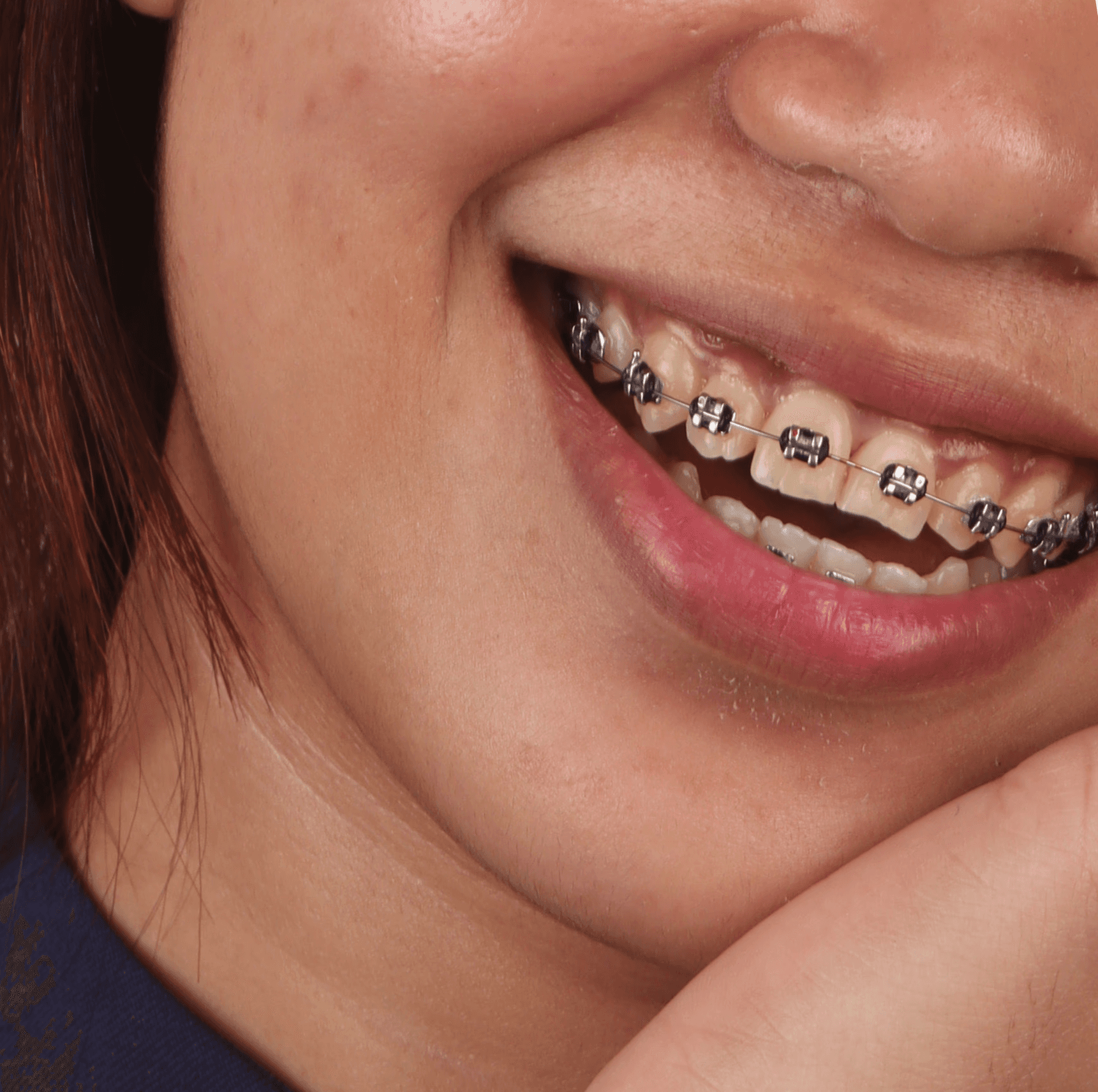 Woman smiling with straight wire braces, highlighting professional orthodontic treatments and teeth alignment at Ora Dental.
