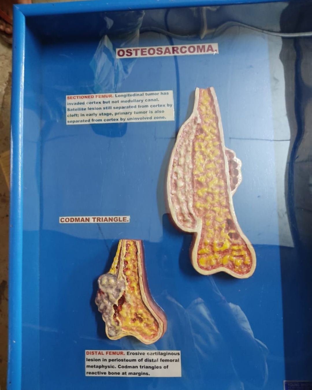 Osteosarcoma