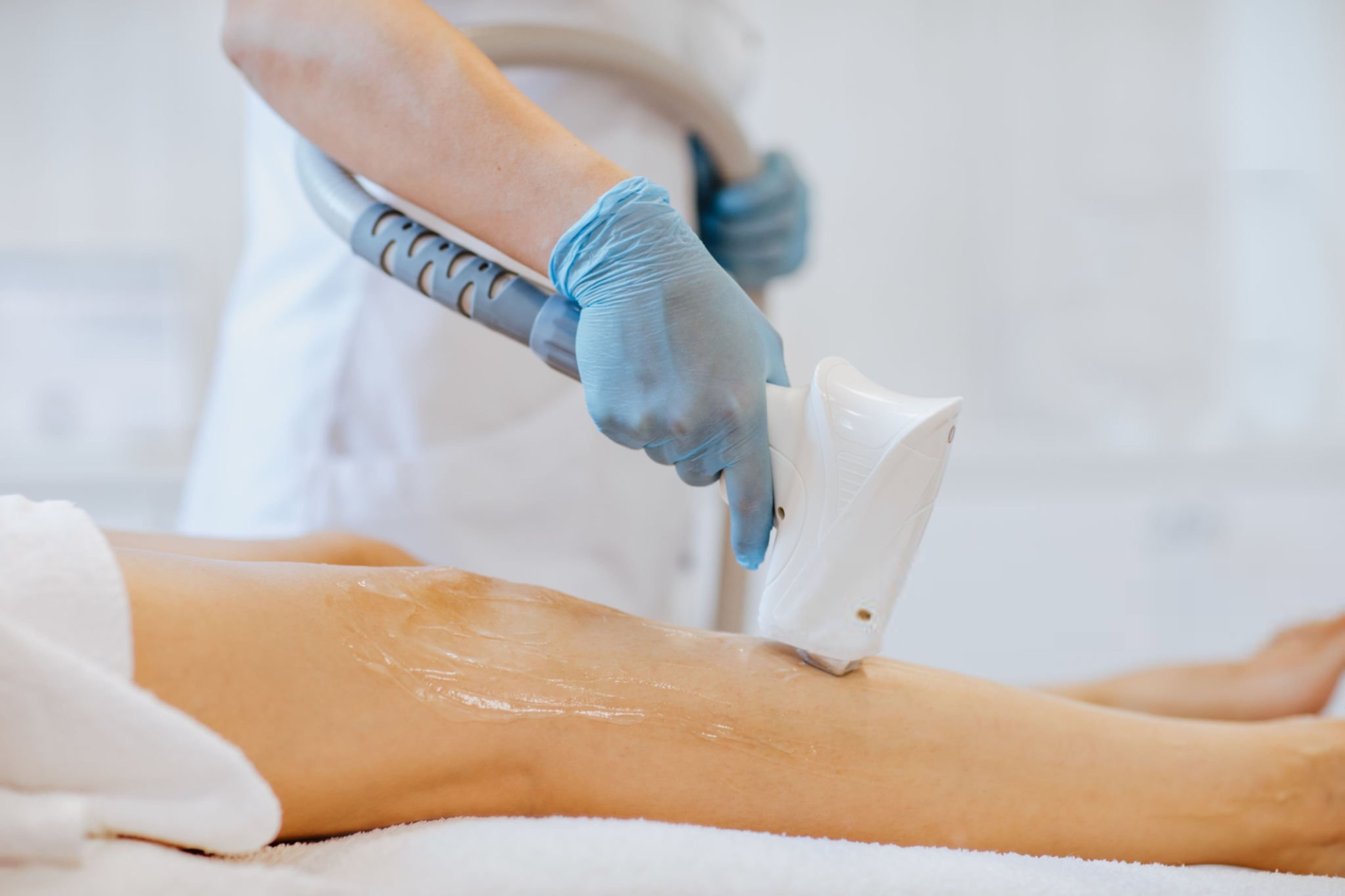 laser hair removal procedure