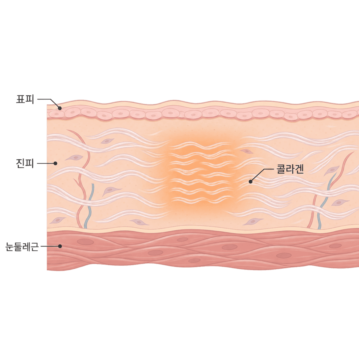 열을 받은 진피 콜라겐이 바로 오그라들고, 몇 달에 걸쳐 다시 채워져요