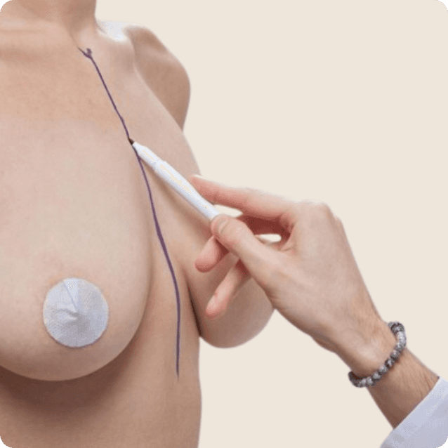 Close-up view of a woman's chest area before a breast lift, showcasing natural breast shape and position. The individual has a neutral expression, and the clinical setting includes markings indicating areas of focus for the surgical procedure aimed at enhancing breast firmness and contour.