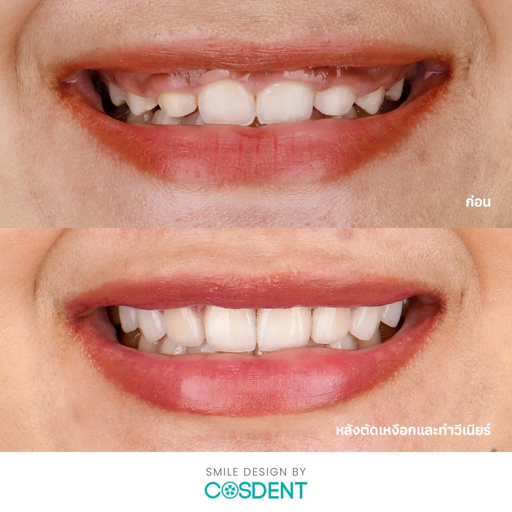 รีวิวออกแบบรอยยิ้ม ที่ cosdent smile design