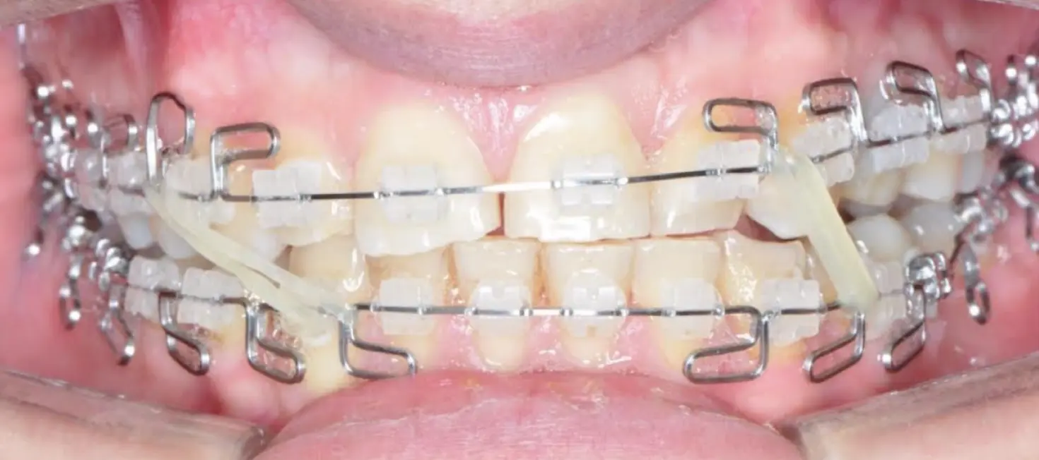 Trattamento funzionale con multi-loop edgewise archwires (MEAW) realizzati a mano 