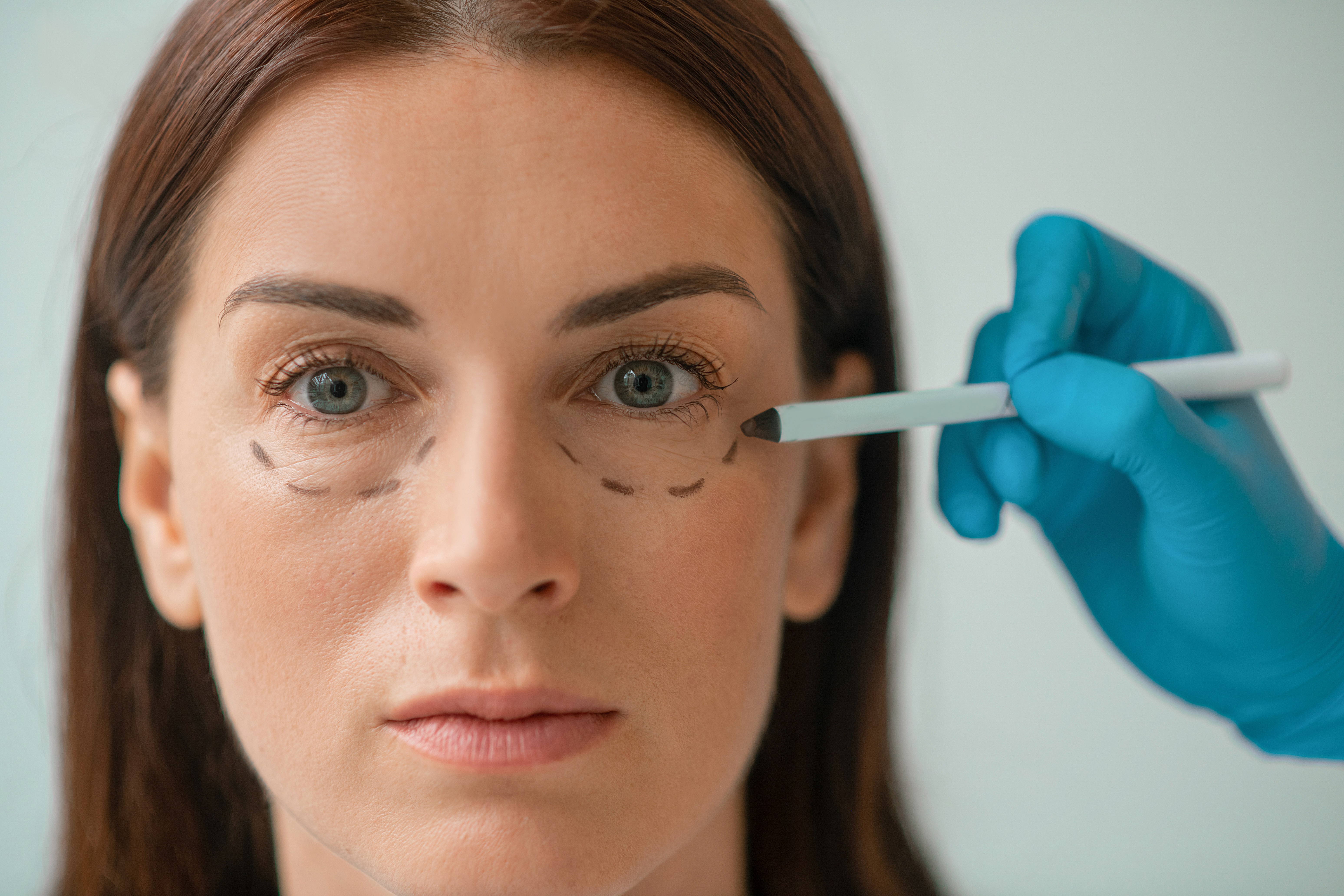 Expertos en Relleno de ojeras. Heaven Clinics