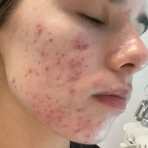Before lipids and ceramides treatment at The Vancouver Aesthetician — young skin with hormonal acne, dehydration, and compromised skin barrier