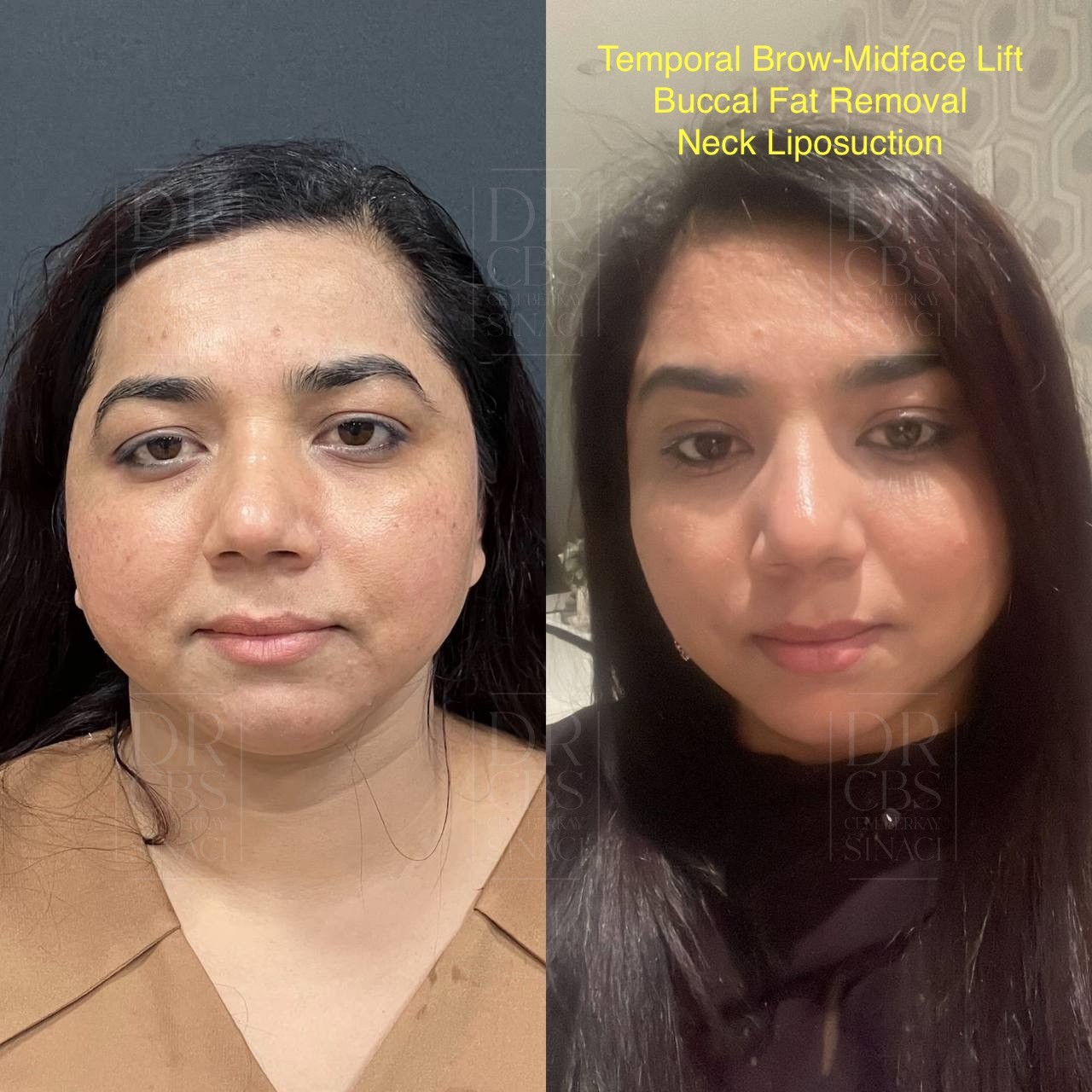 before after temporal lift buccal fat removal and chin liposuction