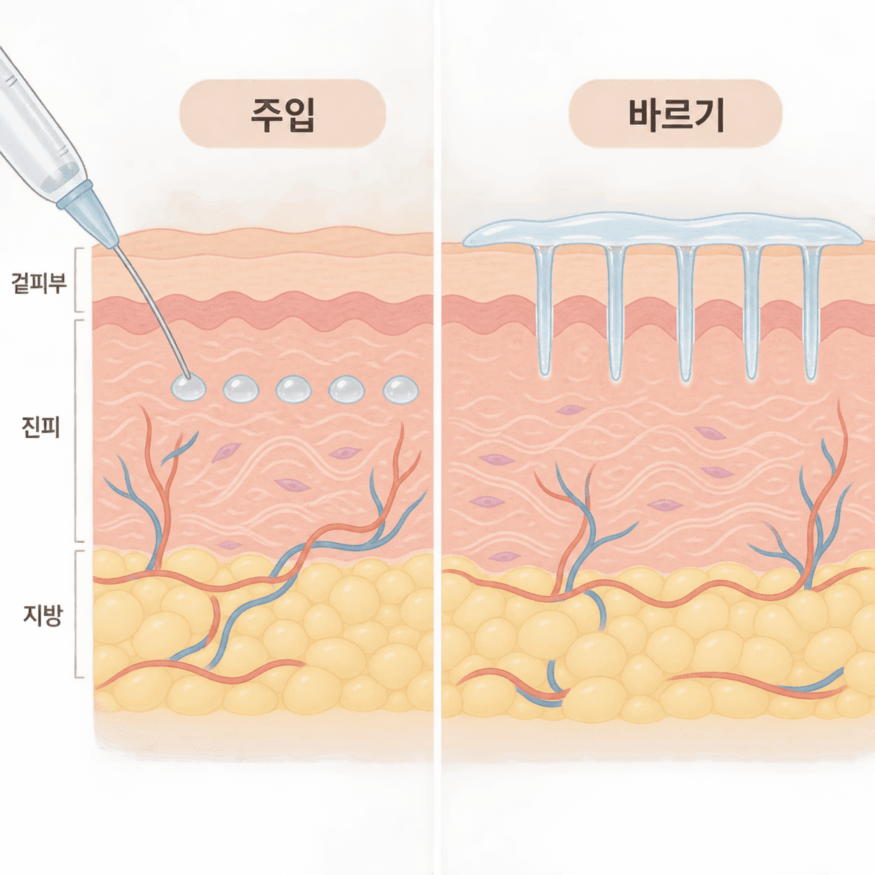 물광주사는 진피에 직접 넣고, 엑소좀은 레이저로 낸 통로 위에 바르는 방식이 연구됐어요