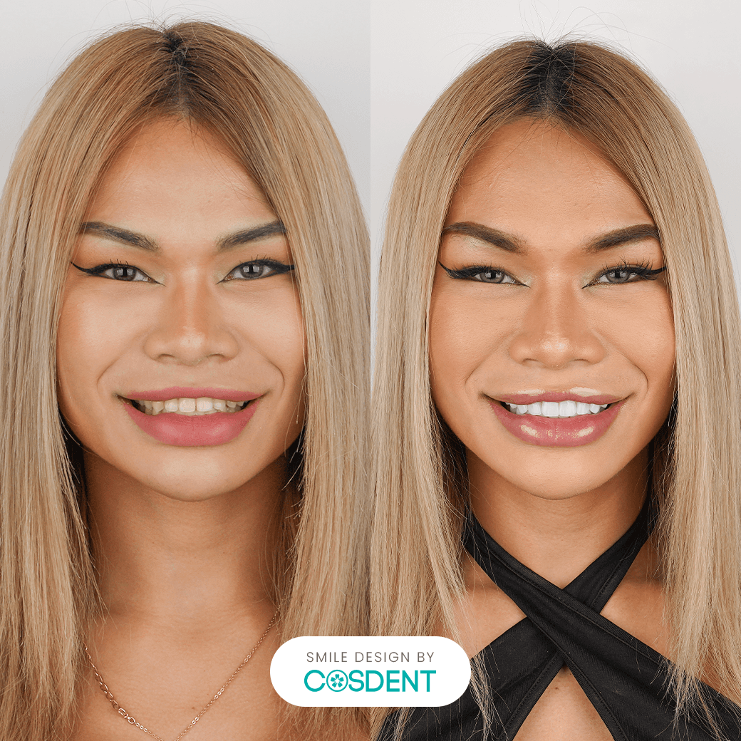 หน้าเหลี่ยม ยิ้มกว้าง 20 ซี่