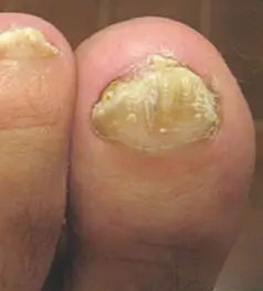 Close-up of toenail fungus infection on big toe.