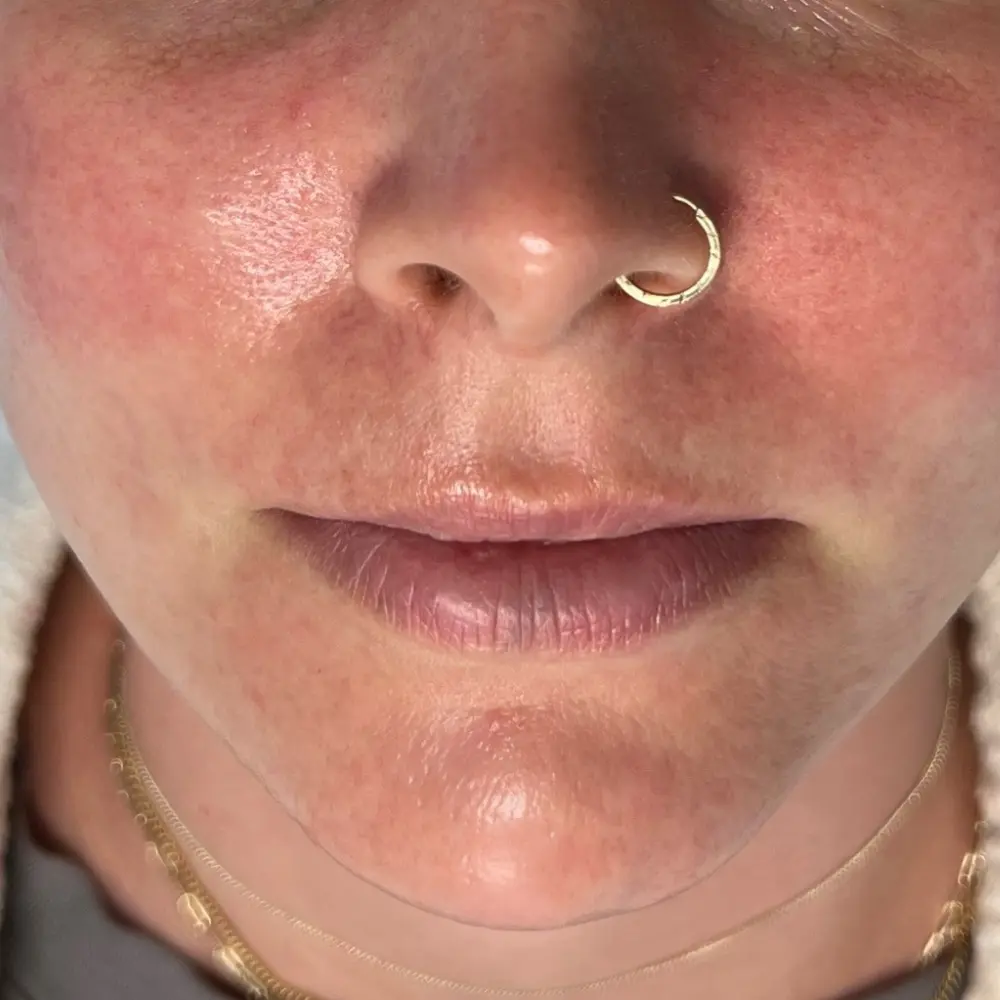 After a series of enzyme facials at The Vancouver Aesthetician — rosacea and redness visibly soothed, calmed and skin tone noticeably more even