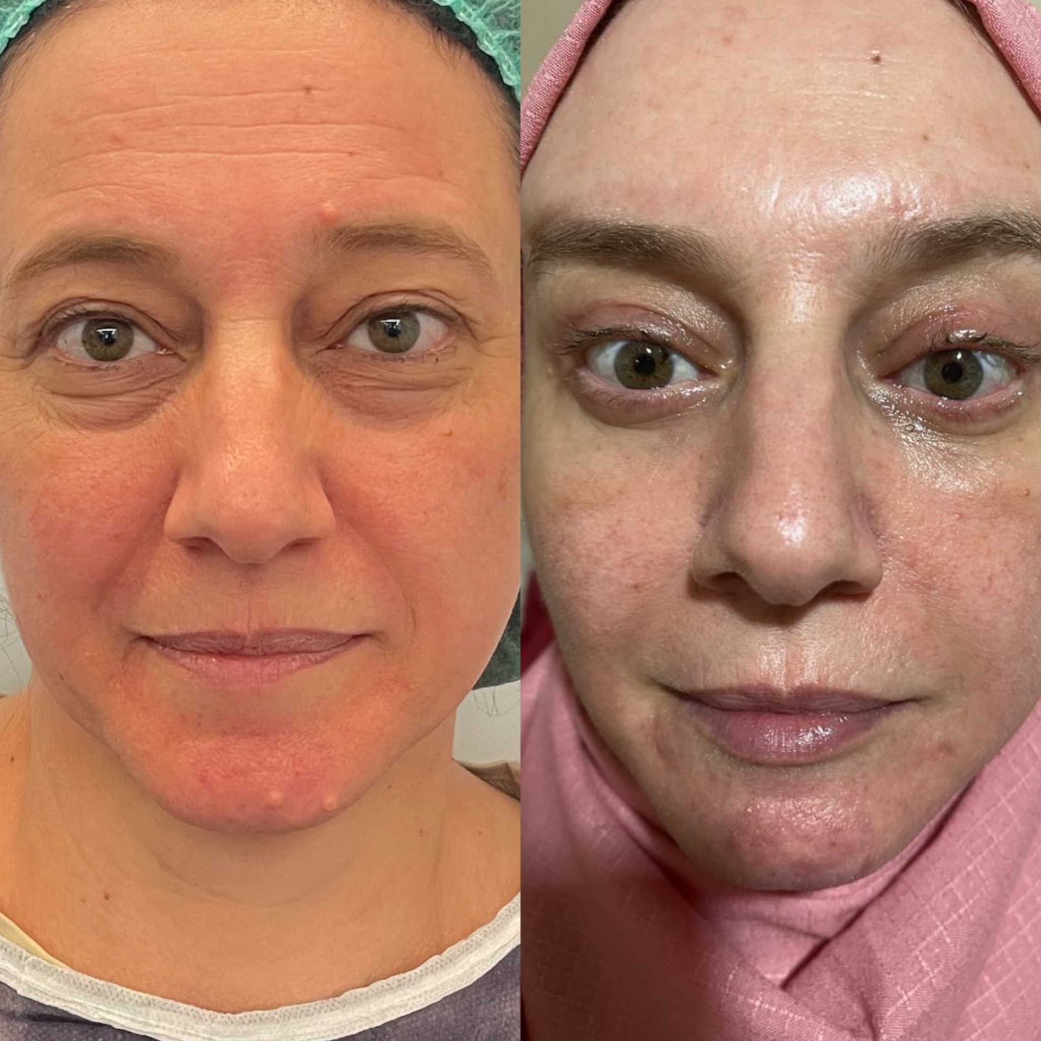 upper and lower blepharoplasty with browlift 3 weeks post-op before after 