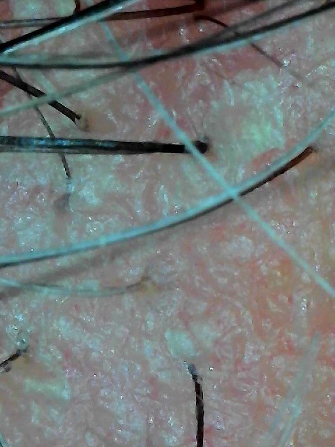 Microscopic close-up of an oily, eczema-prone scalp with flakes and hairline irritation before treatment