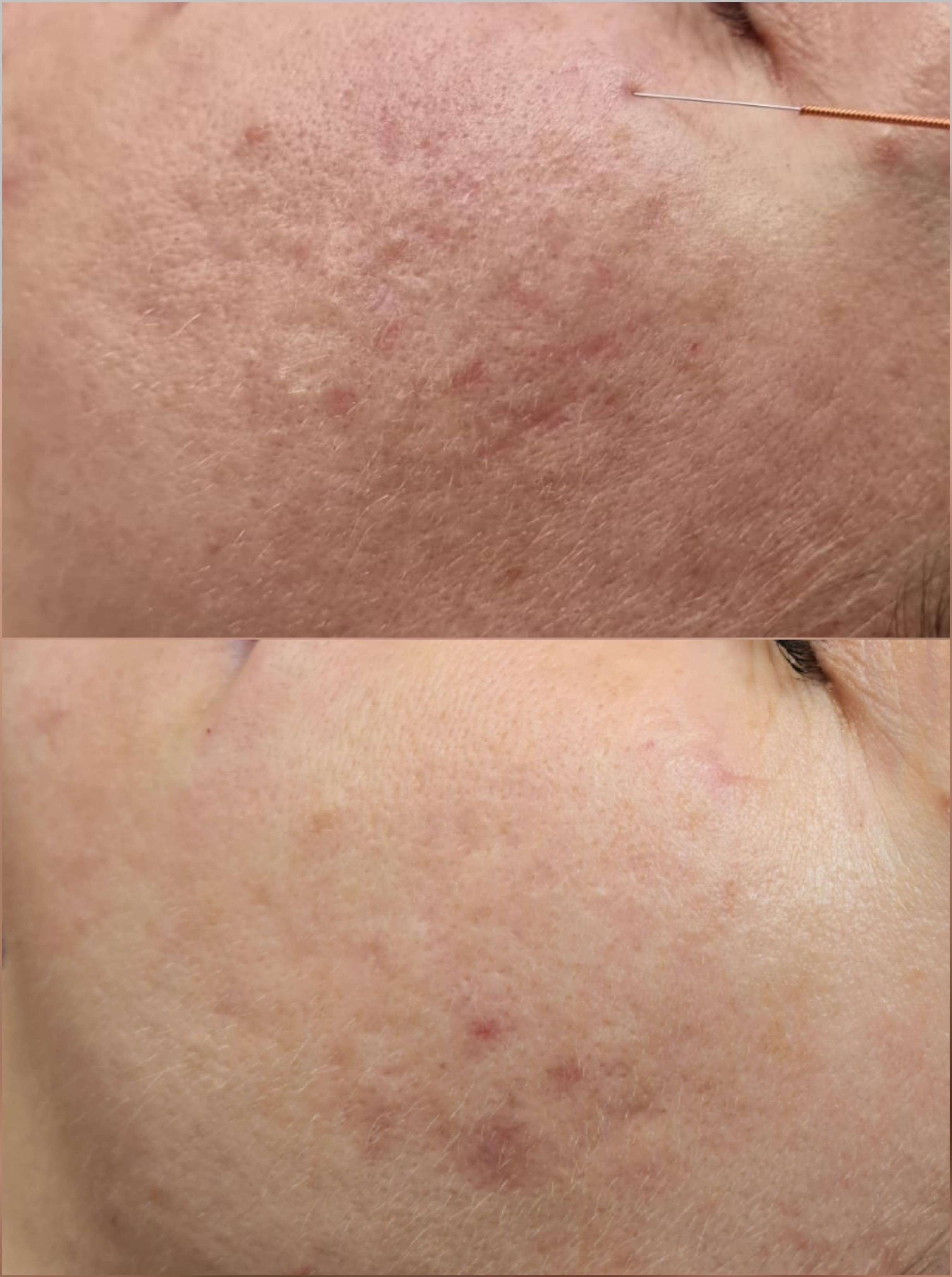 Neuroscars efekt_jednego_zabiegu_estGen_Leszczenko_szczecin_blizny_potraÌ¨dzikowe