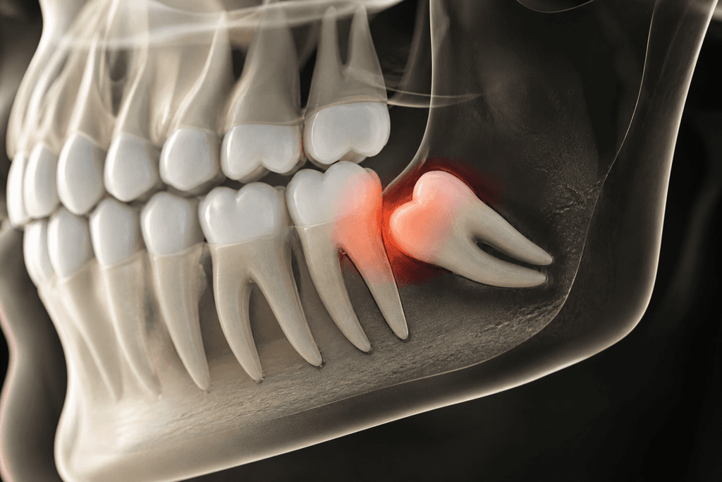 Dental Braces