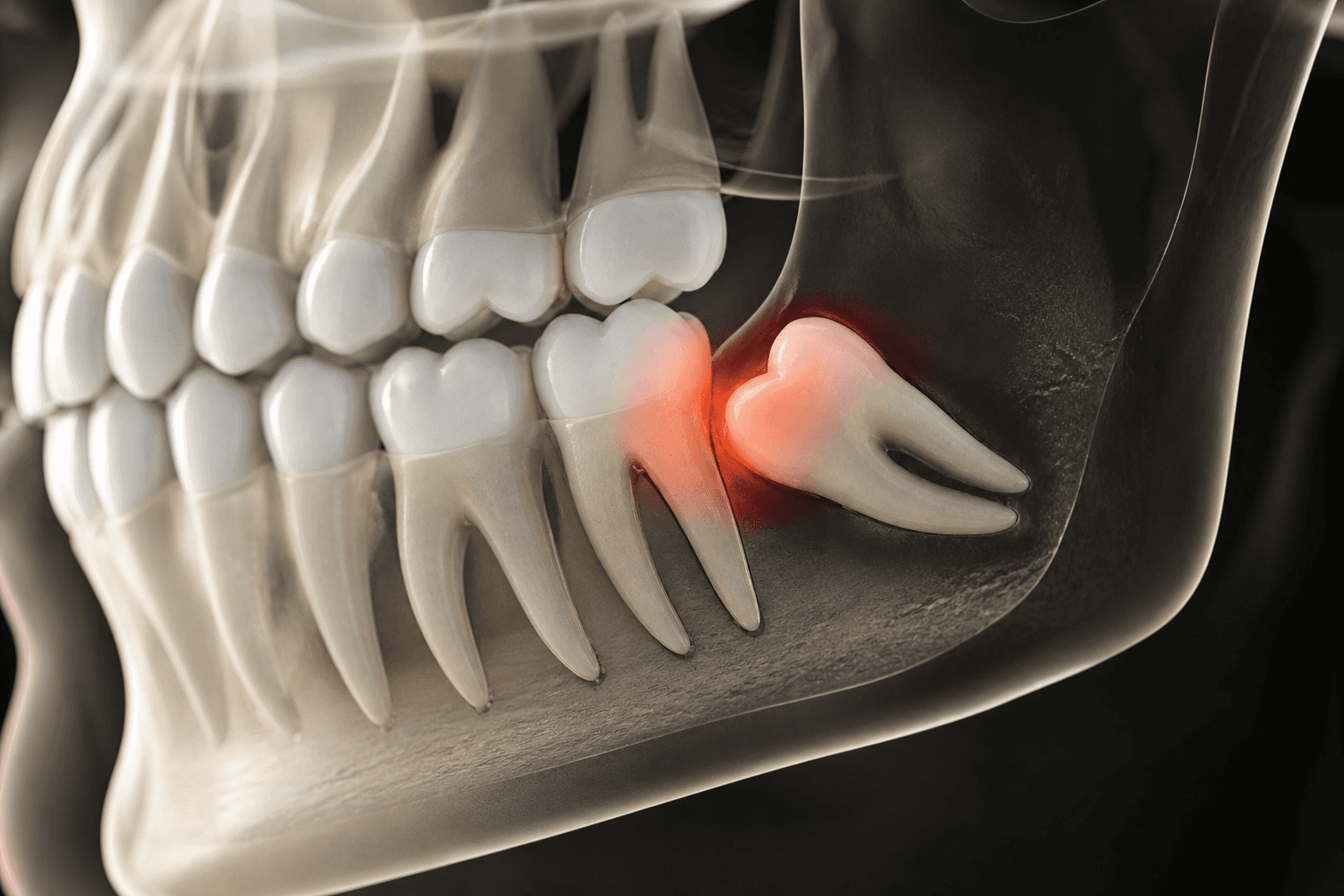 Dental Braces