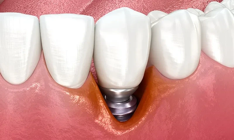 dental implants infection