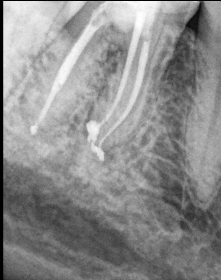 Dental X-ray image showing a molar with a completed root canal treatment, featuring visible dental fillings, next to a healthy adjacent tooth, highlighting dental health and endodontic care at Oakville Dental Studio