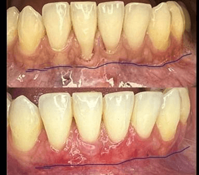Periodontics - Gum Graft