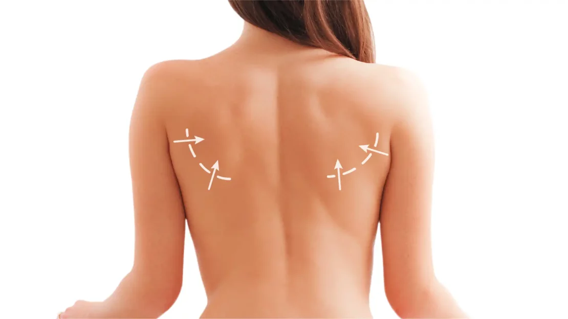 Fettabsaugung am Rücken