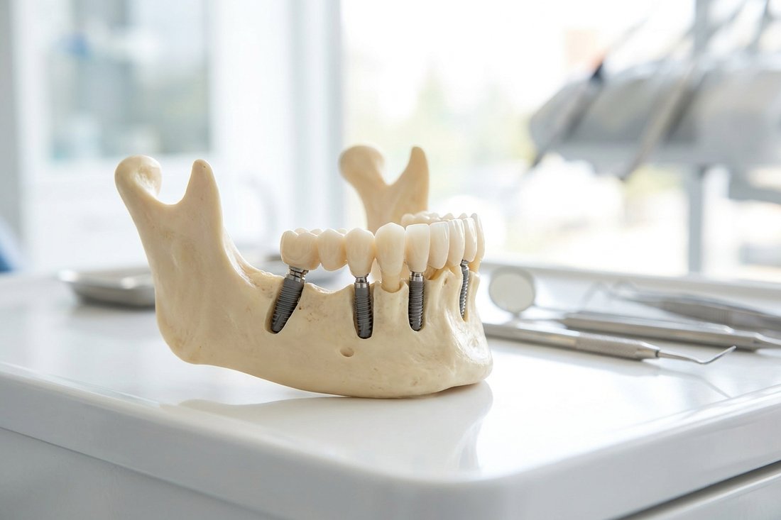 Jaw model showing four angled implants supporting a full fixed arch of teeth