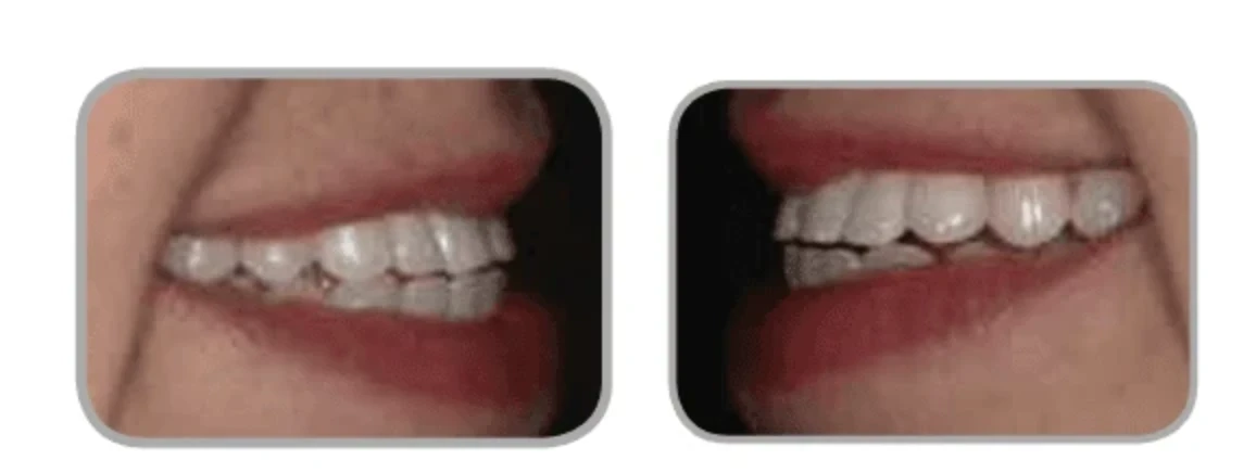 Solutions for Limited Interdental Spaces | Bloor-Yorkville Periodontics