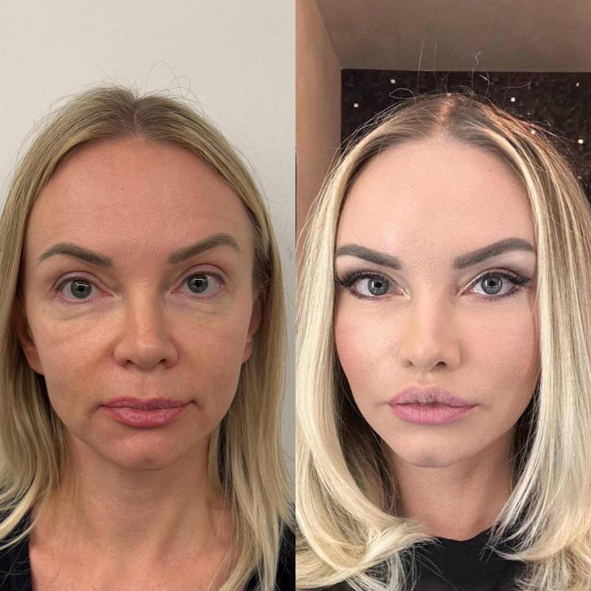 1 month post-op result of deep plane face lift with makeup before after photo