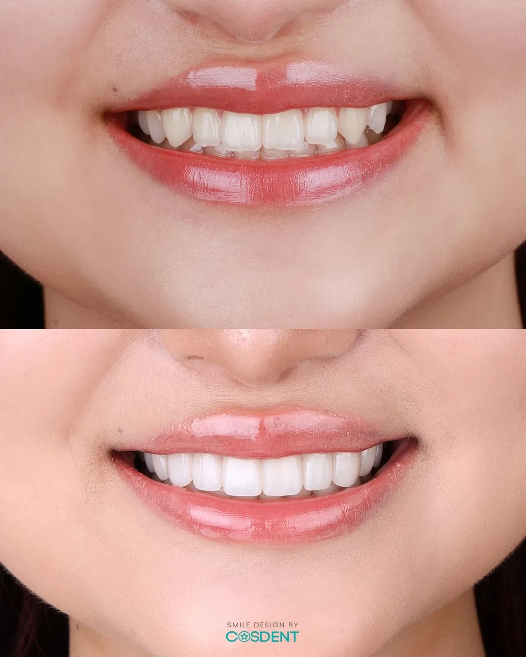 Two close-up smile photographs showing differences in tooth shape and colour.
