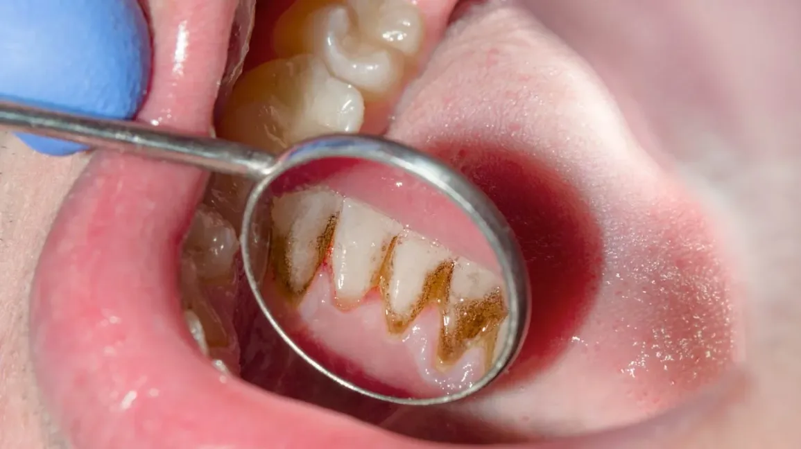 Dental Scaling and Root Planning