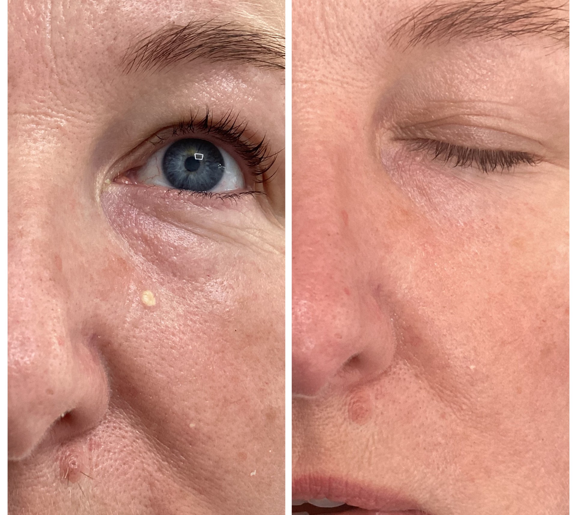 Laser treatment on woman's cheek with protective eye shield