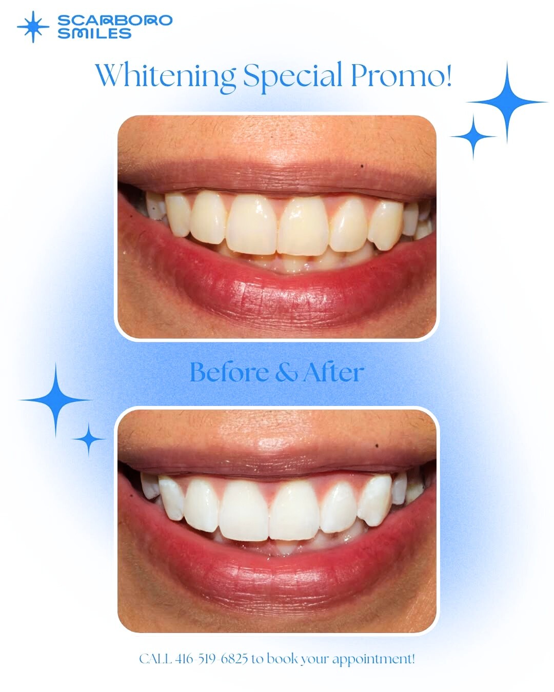 Teeth Whiteting Promotion at ScarboroSmiles in Scarborough, Ontario