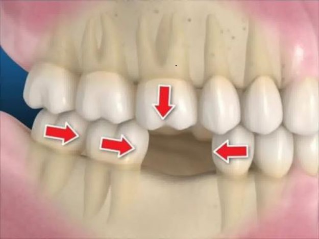 Fogászati implantátum (műgyökér beültetés)