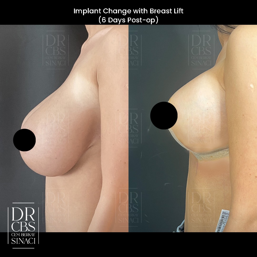 breast implant change with breast lift 6 days post-operative before after side view