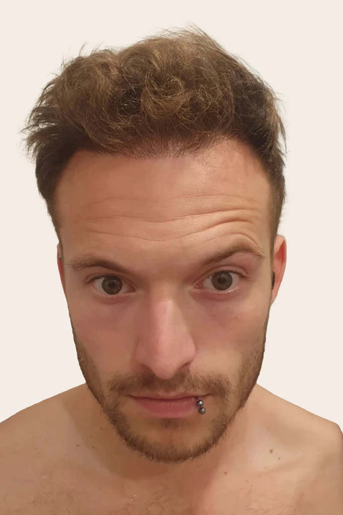 Natürlicher Haaransatz und dichtes Haar bei Brillenträger nach der Haartransplantation