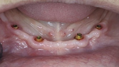 Fogászati Implantátum Tájékoztató